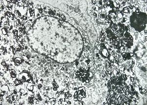 F,68y. | spleen - myelinoid inclusions - clin. susp. leukemia F,68y. | spleen - myelinoid inclusions - clin. susp. leukemia